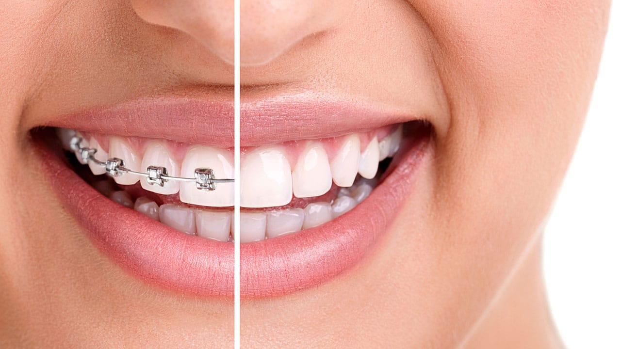 Orthodontics treatment in Wakad, Pune - Wonder Glow and Smile Clinic