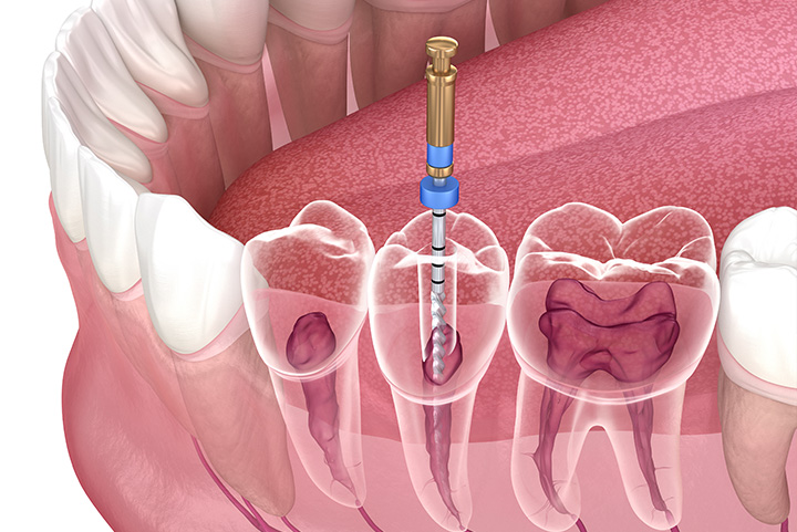 Root Canal Treatment in Wakad, Pune - Wonder Glow and Smile Clinic