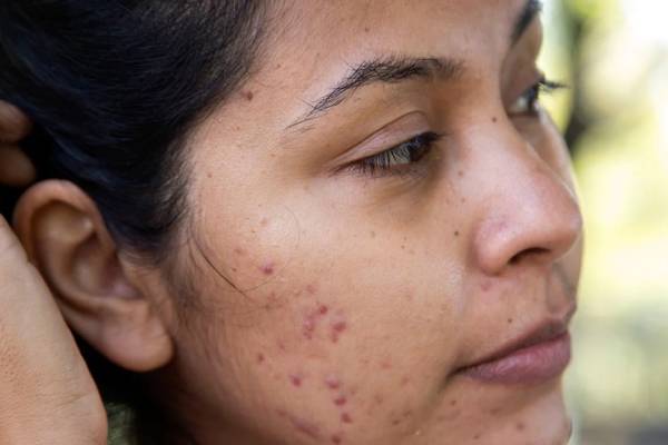 Acne Scar Treatment in Wakad, Pune - Wonder Glow & Smile Clinic